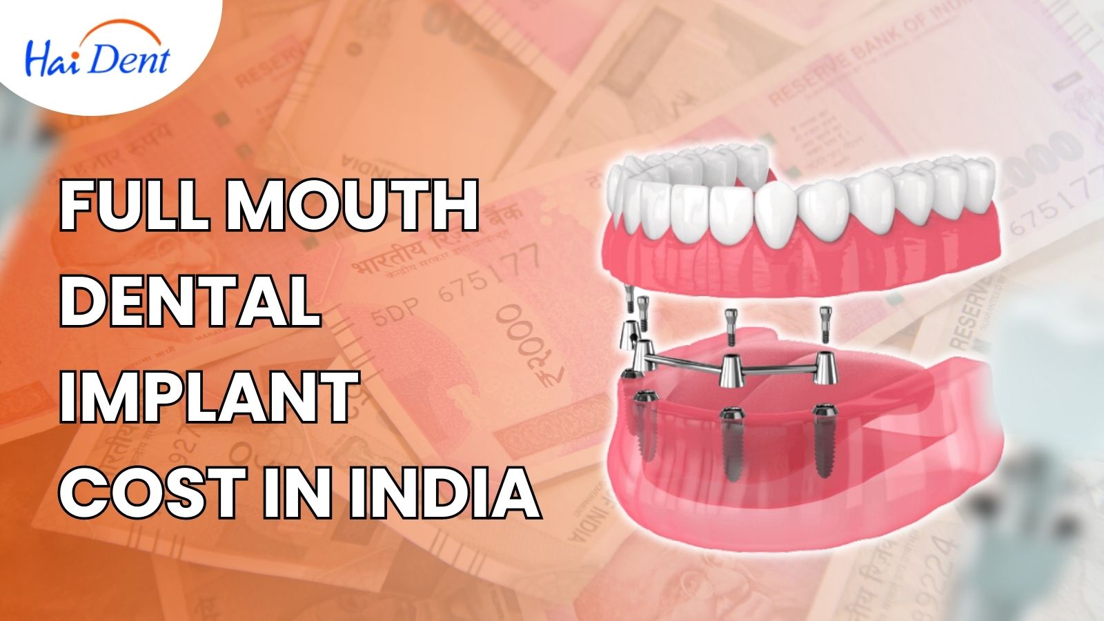 full mouth dental implants cost in india